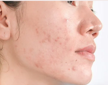 Post-Inflammatory Hyperpigmentation