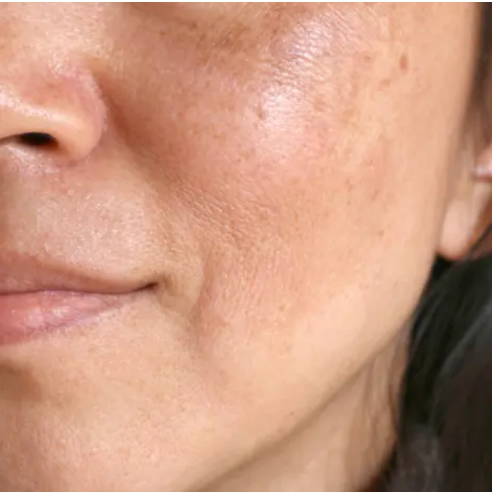 Sun Spots Solar Lentigines